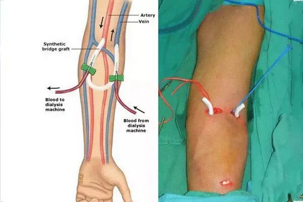 【肾病】血液透析人造瘘是啥?怎么护理?您想知道的都在这里!